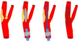 Intervention pratiquée: le stenting carotidien