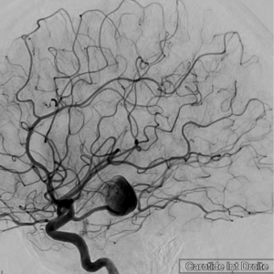 Qu'est-ce qu'une embolisation d'anévrisme cérébral